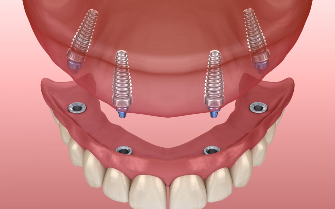 Dental Implants Vs Dentures: What’s Right For You